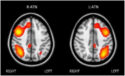 Computer-Based Cognitive Training Improves Brain Functional Connectivity in the Attentional Networks: A Study With Primary School-Aged Children